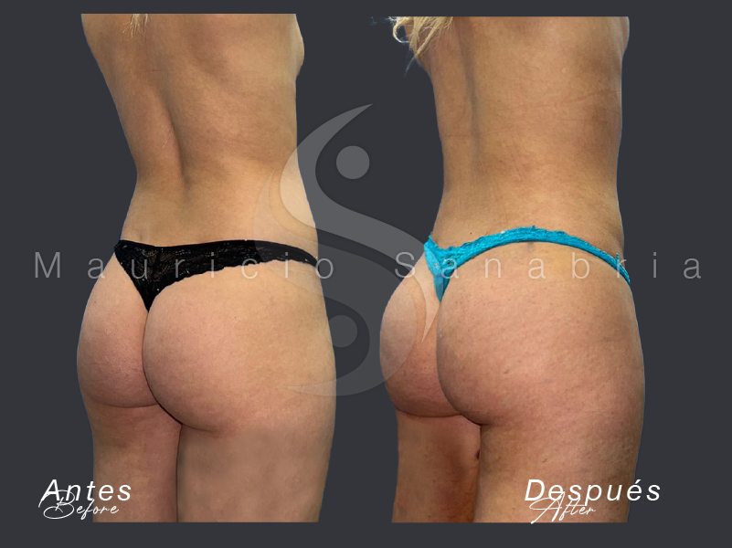 gluteoplastia